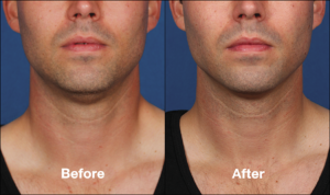 Kybella