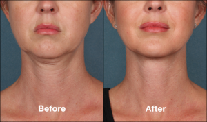 Kybella