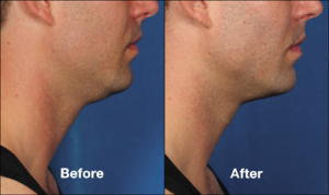 Kybella