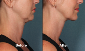 Kybella
