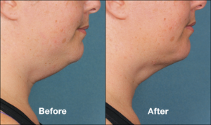 Kybella