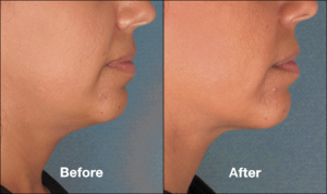 Kybella