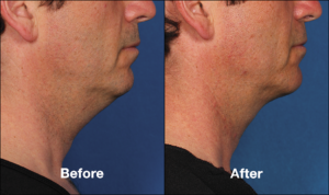 Kybella