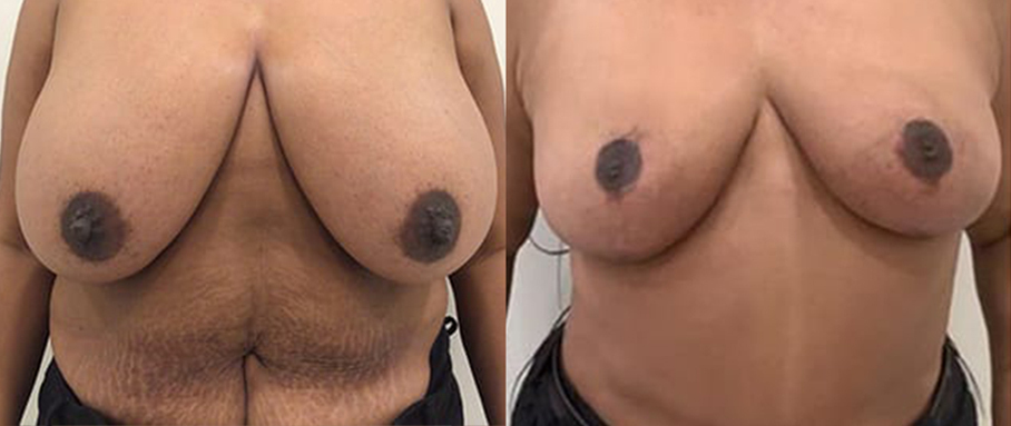 Breast Lift in NJ
