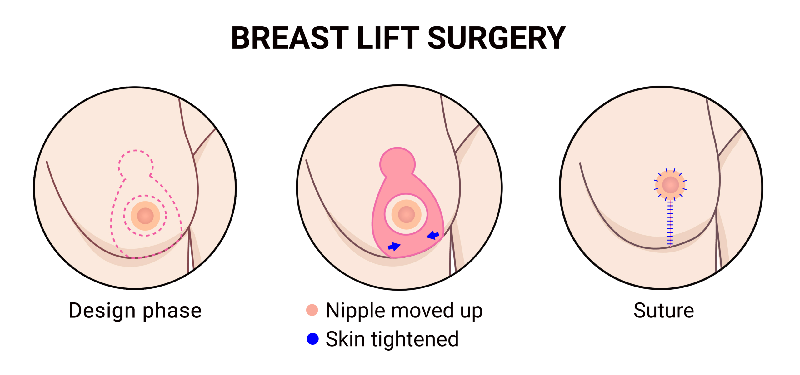 Breast Lift Procedure