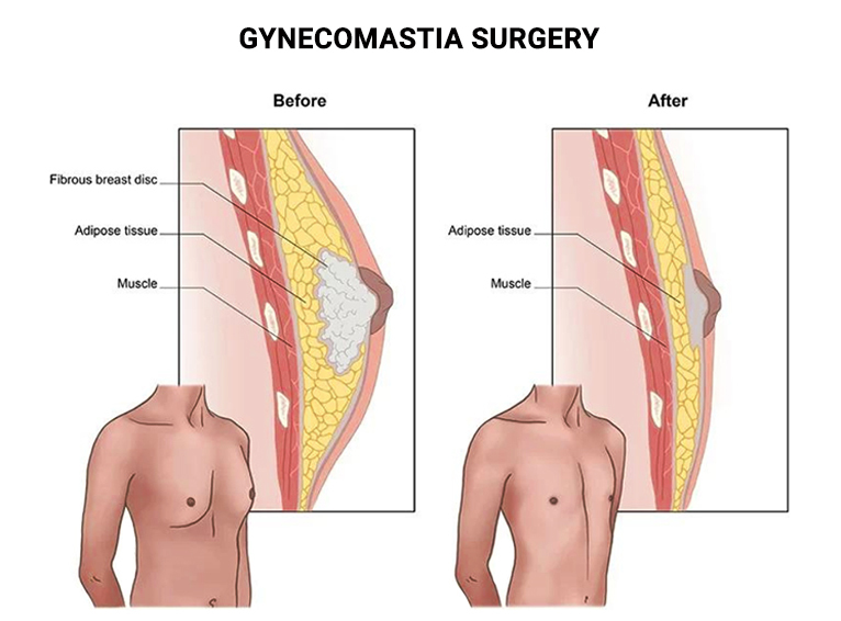 Gynecomastia Surgery in New Jersey