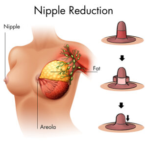 nipple reduction