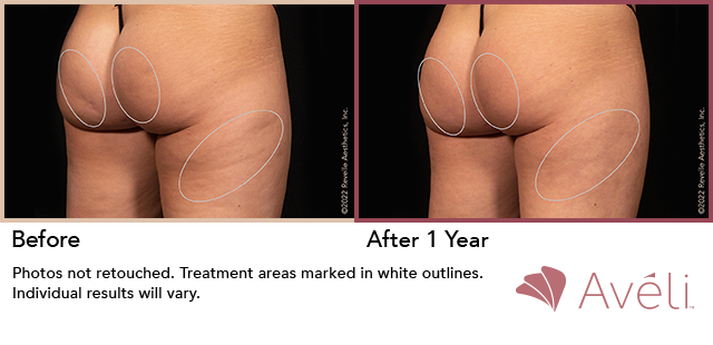 础惫茅濒颈鈩 Before and After