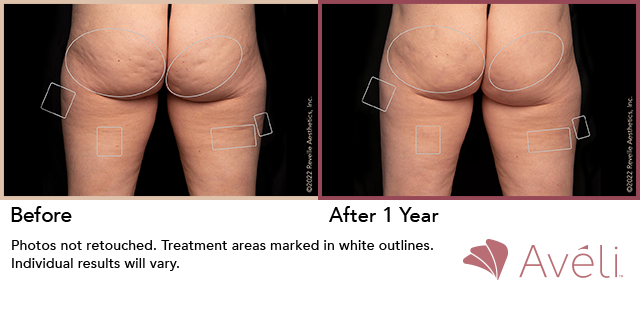 础惫茅濒颈鈩 Before and After