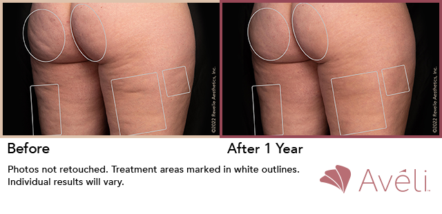 础惫茅濒颈鈩 Before and After