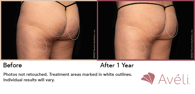 础惫茅濒颈鈩 Before and After