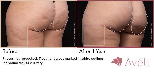 础惫茅濒颈鈩 Before and After