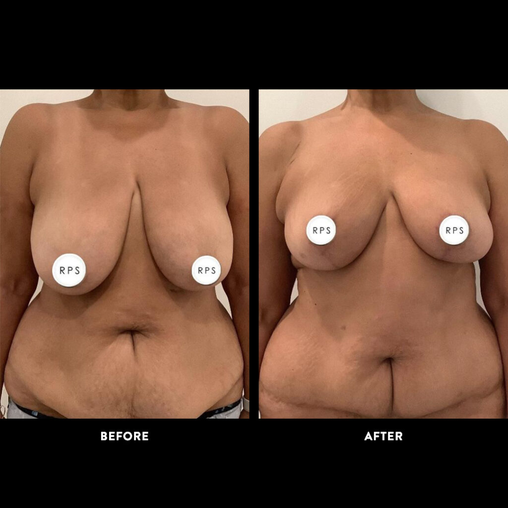 panniculectomy before and after picture