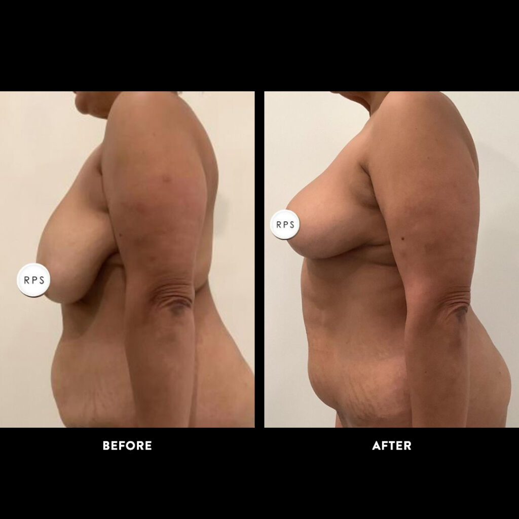 panniculectomy before after