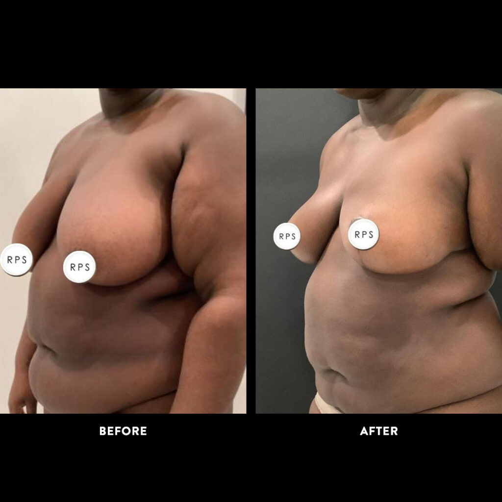 panniculectomy before and after photo