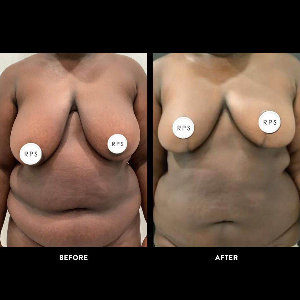 panniculectomy before and after
