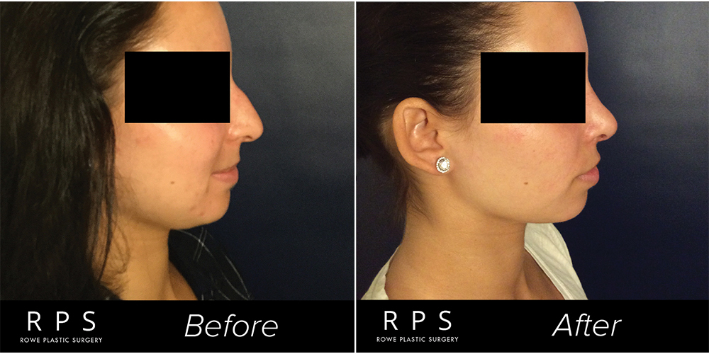 Rhinoplasty Before and After