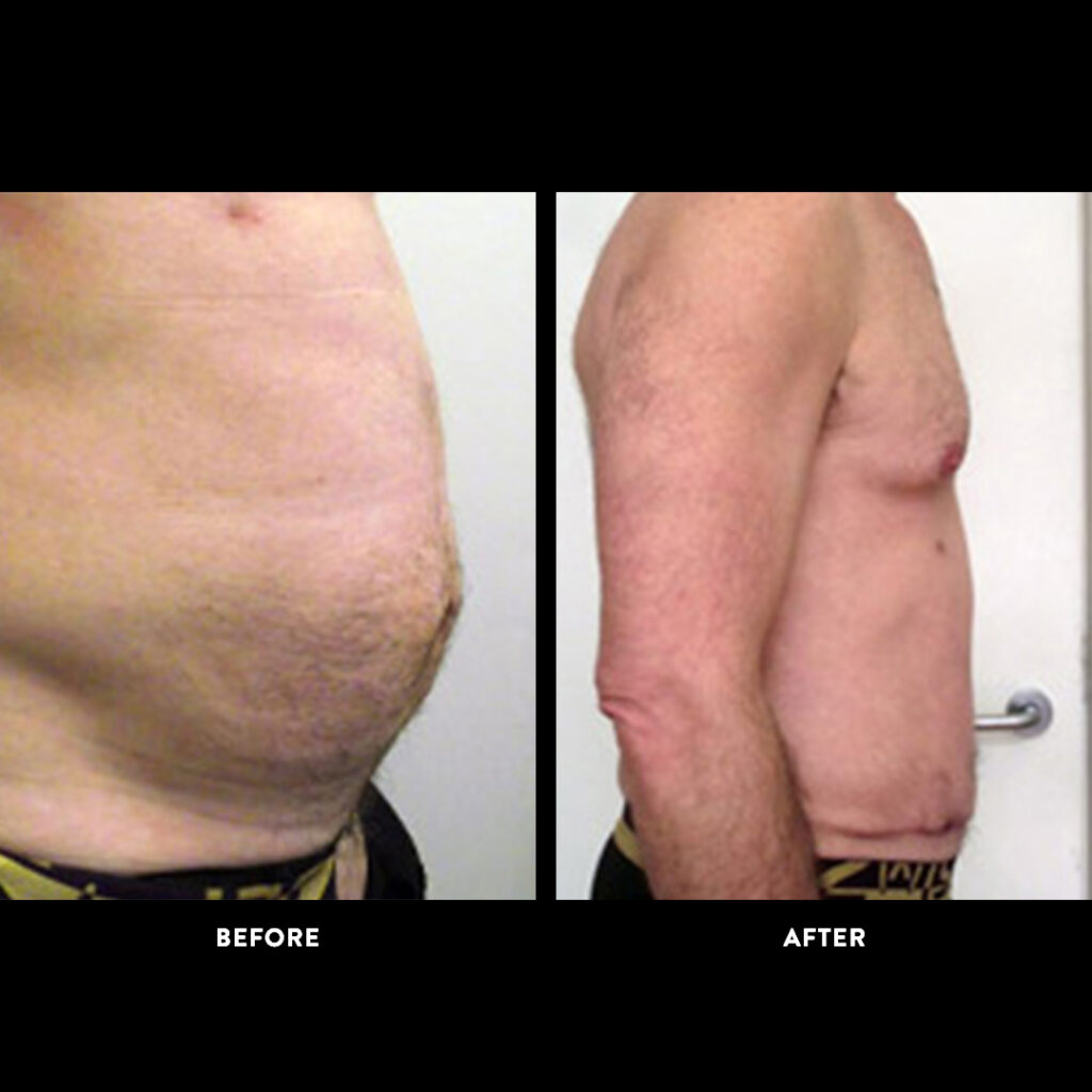 tummy tuck procedure before and after