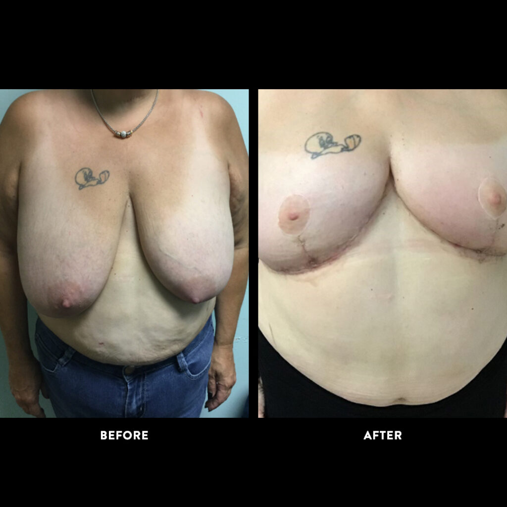 DIEP Flap before & after photo