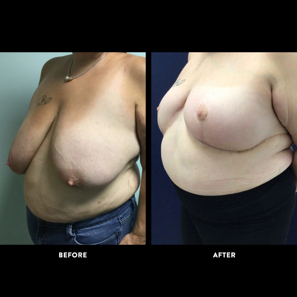 DIEP flap before & after