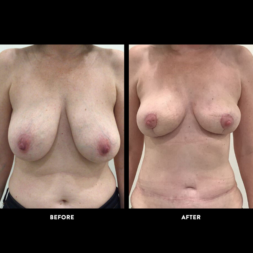 DIEP Flap procedure before & after