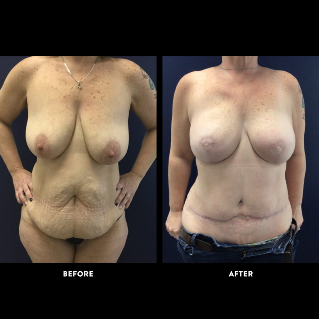 DIEP Flap surgery before & after picture