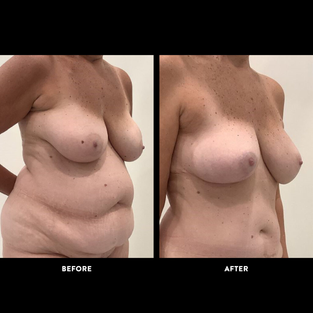 DIEP Flap surgery before & after