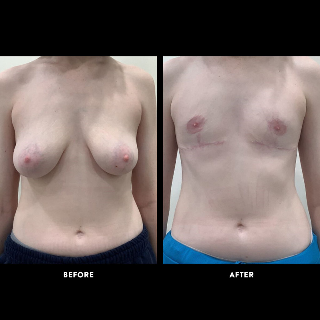 gender affirming surgery before & after