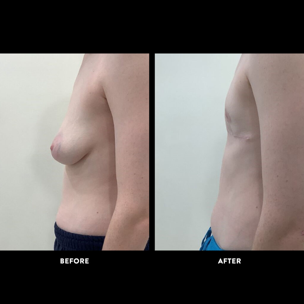 gender affirming before after