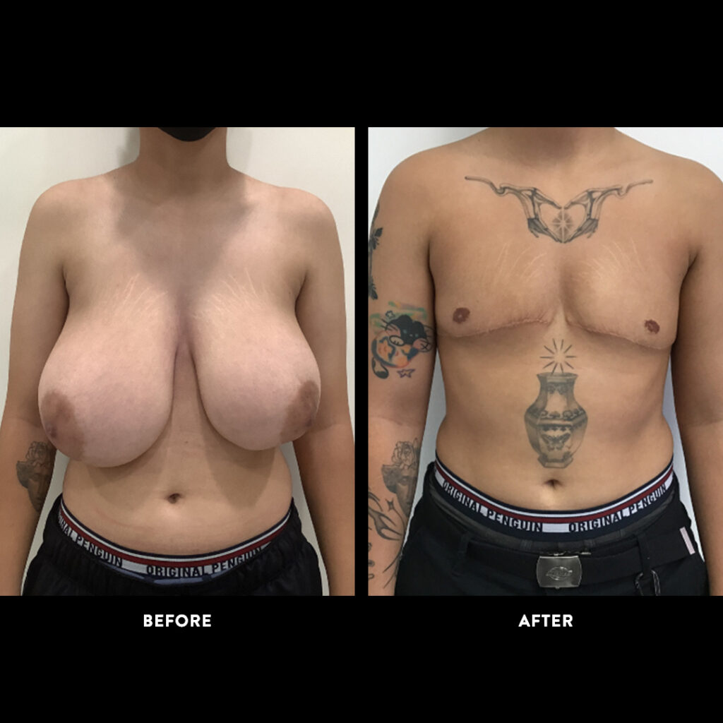 gender affirming surgery before & after photo