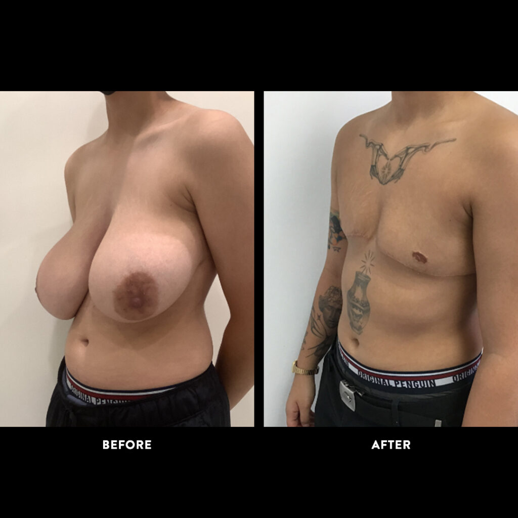 gender affirming surgical procedure before & after