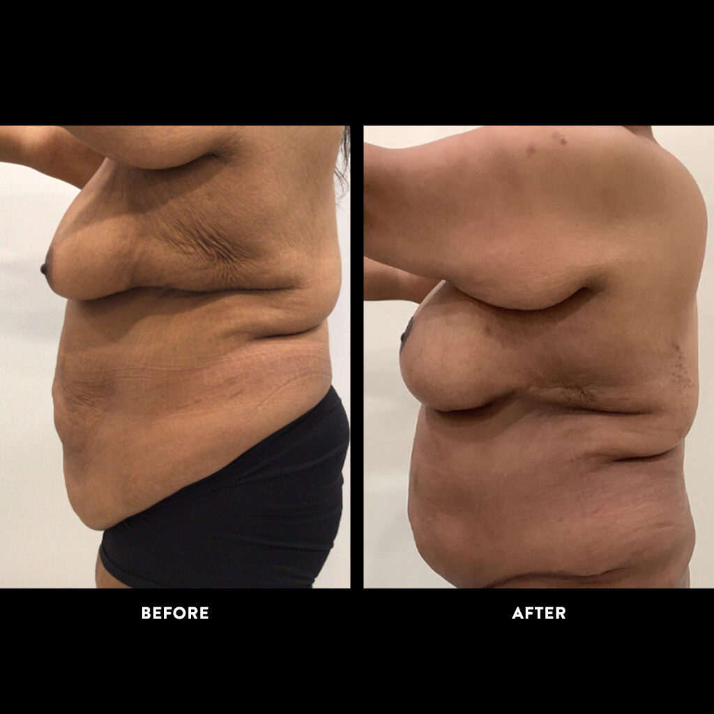 gender affirming procedure before & after picture