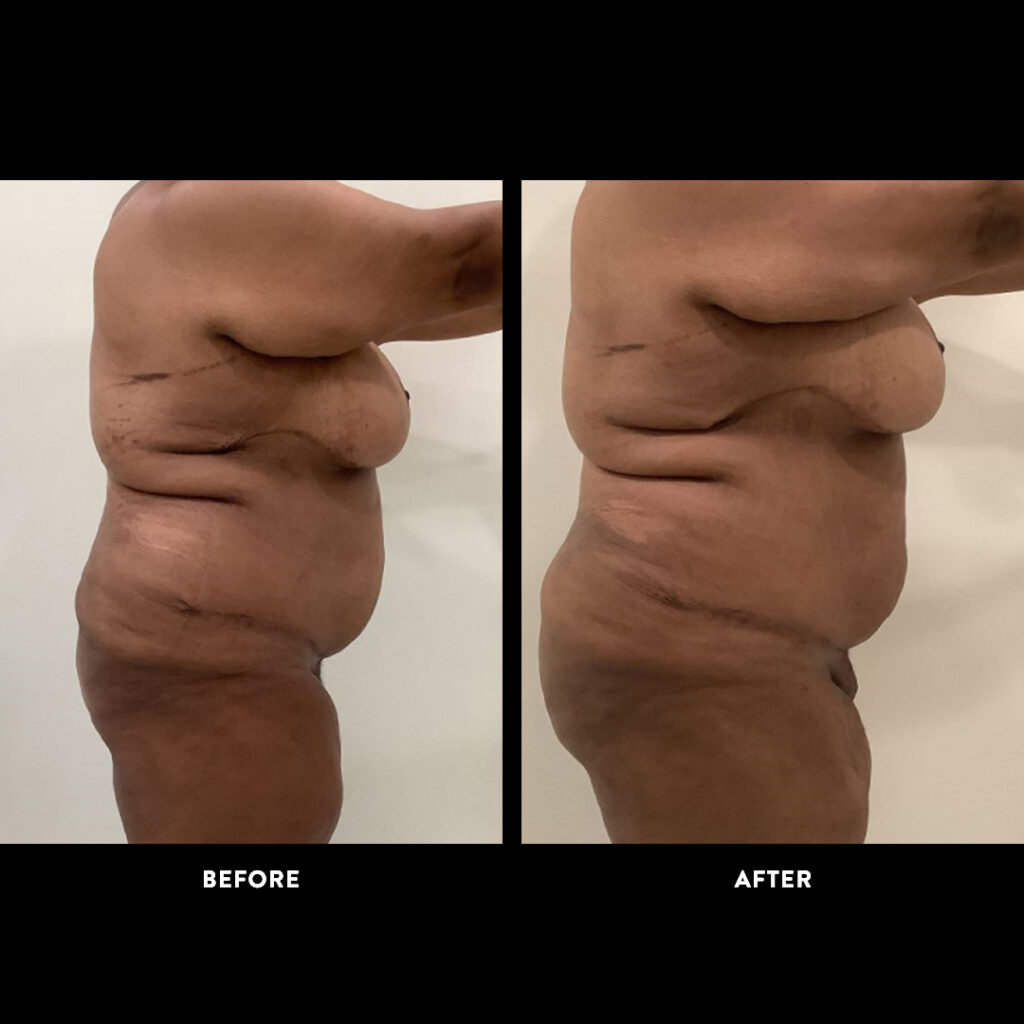 gender affirming procedure before and after photo